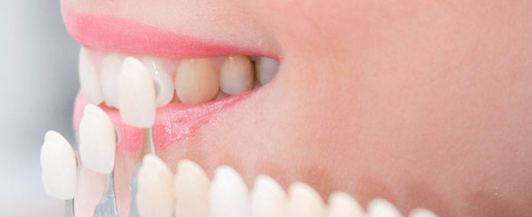 Carillas dentales en Sakar Dental