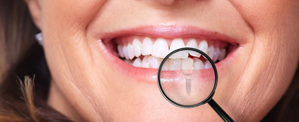 Implantes dentales en Sakar Dental
