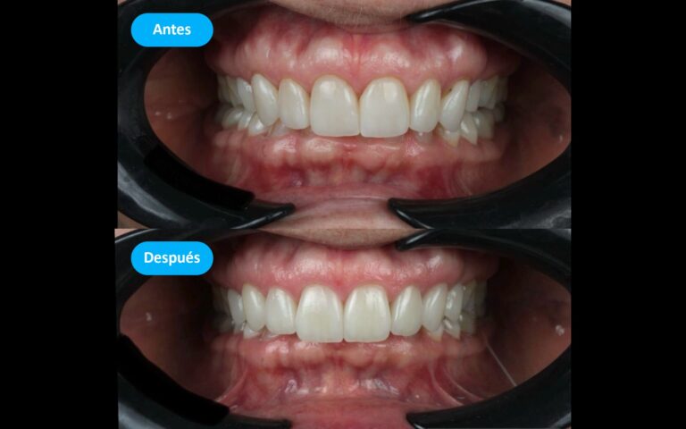 Before_After_6